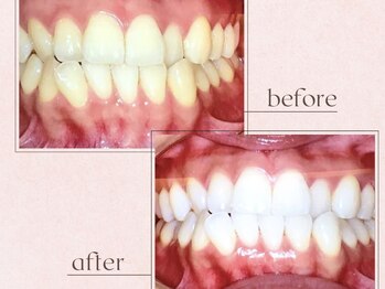 ルアナシンフォニア エクシア 池袋店(Luana-Sinfonia)/ホワイトニングビフォーアフター