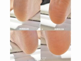 足裏角質除去