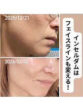 フレル(FUREL)/気になるフェイスラインも