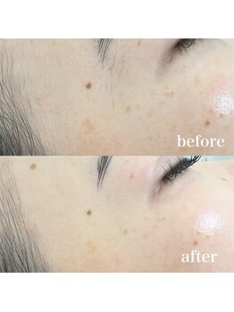 ラクシー 御徒町(luxssy)/顔シェービング