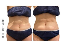 ラリマ(La-lima)/60代/痩せないウエストに