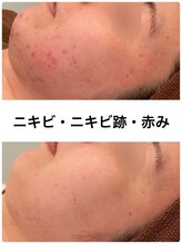 ビオエル 横浜店(Bioel) 肌トラブル 改善