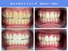 エクシアホワイトニング 岡崎店/歯の黄ばみ撃退★白さ満足度No.1