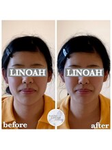 リノア 心斎橋店(LINOAH)/ウルトラプラス小顔リフト b→a