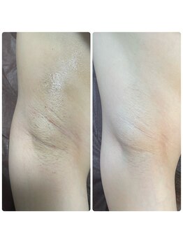 ビューティーホームサロン(Beauty Home Salon)/全身脱毛