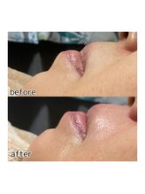 アデル 久留米(ADEL)/《全顔》口元ワックス