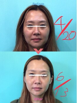 高宮レディース鍼灸整骨院/小顔矯正before&after