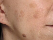 エステティックガーデン小町ストーリー/シミしわ改善【アフター】