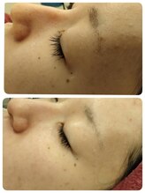 マールム(MALUM)/ハーブピーリング　before/after