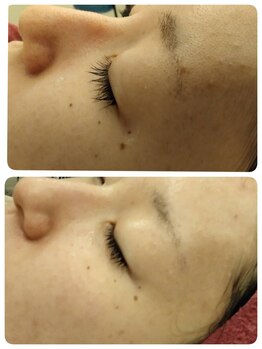 マールム(MALUM)/ハーブピーリング　before/after