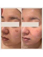 ベルタ(BELTA)/ケア前→3ヶ月後 　シミ