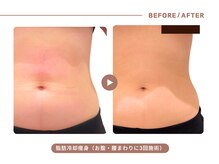 イエス マイサロン(yes My Salon)/脂肪冷却施術例
