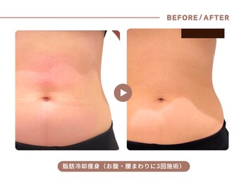 イエス マイサロン(yes My Salon)/脂肪冷却施術例