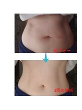 ラブリエ(Labriller)/最新痩身機器ウルトラの威力★