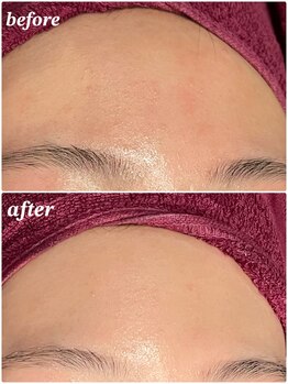 ソルエユニーク(Le seul et unique)/おでこのザラつきサヨナラ！！