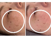 カランコエ(KALANCHOE)/残ってしまった跡ケアに★