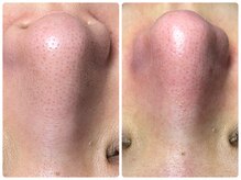 マリアム(mariam)/毛穴エクストラクション