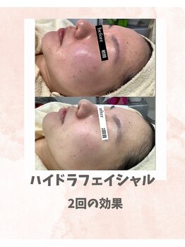 リンフェイス 浦安店(RINFACE)/1年中気になる赤みにも