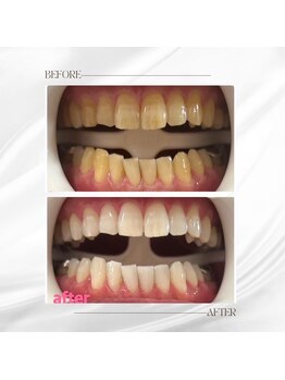 ホワイトニングセンター 大阪羽曳野店/歯科提携ホワイトニング症例