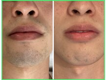 クリア 尾張旭店(Clear)/【Clear脱毛ビフォーアフター】