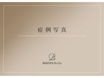 ベル 西宮北口(Belle)/ハーブピーリング｜写真