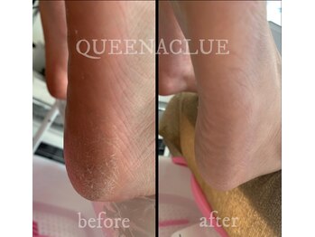 クイーナクルー(QUEENA CLUE)/足裏角質ケアマシンでフワフワ