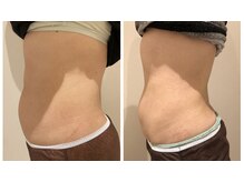 エイシスグロウ(asis glow.)/効果写真