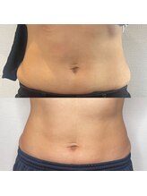 プルメリア(Plumeria)/数回でこの変化！