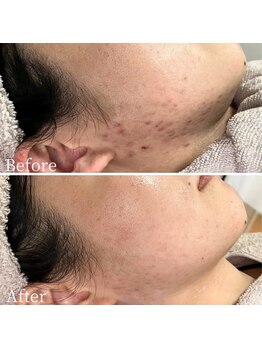 ニキビケア研究所 所沢店/ほほ・あごニキビケアに!