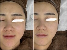 フォー(For...)/たるみケアは予防が大切！