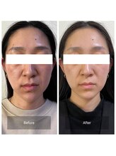 ビーアット(b-atto)/フェイシャルビフォーアフター