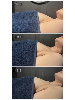 リルマコ/バスト症例写真