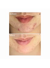 ホワイトアクア 加古川店(WHITE AQUA)/ハーブピーリング/毛穴/加古川