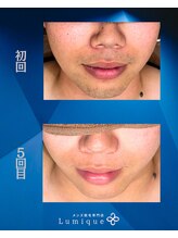 ルミーク(Lumique)/Before After N様