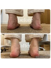 ポドウオーク(PODO WALK)/足首の変形