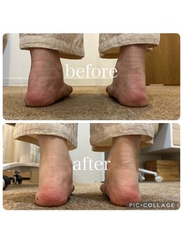 ポドウオーク(PODO WALK)/足首の変形