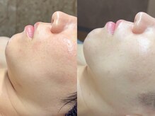 エモーショナル 姫路(Emotional)/セラピール＋LDM10回【乾燥】