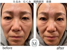 ミヨン(Miyong)/目元のたるみ・むくみもスッキリ