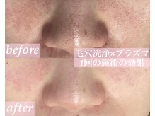 ローズドゥシャロン(Rose de CHALON)の雰囲気(【黒ずみ毛穴・角栓・皮脂撃退】汚れを洗い流し毛穴も引き締め★)