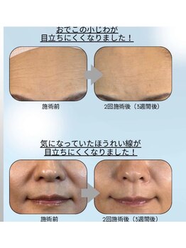 ココサロン(Coco Salon)/美容液導入