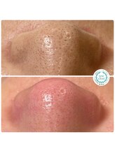 ソート(THOUGHT)/毛穴エクストラクションtete