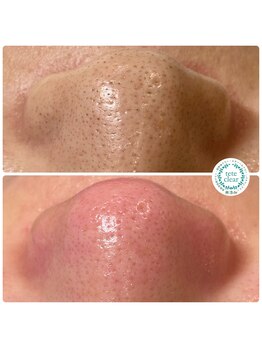 ソート(THOUGHT)/毛穴エクストラクションtete