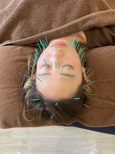 ベルソー鍼灸整体院(berceau鍼灸整体院)/美容鍼施術