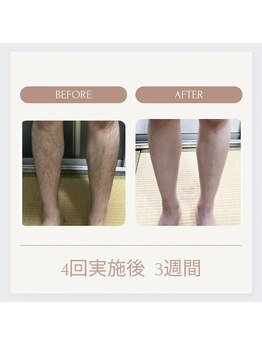 美々庵/メンズ脱毛◇全身脱毛