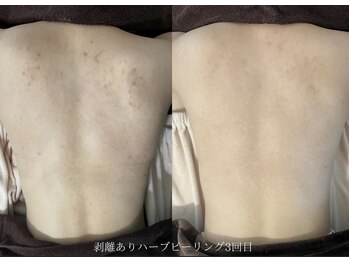 アイル 高槻店(iru)/背中の剥けるハーブピーリング