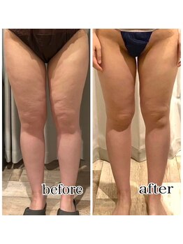 レイール(Reir)/メディセル 美脚コース