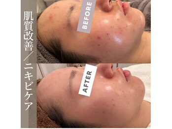 シンデレラ しみケア(Cinderella)/ニキビケア