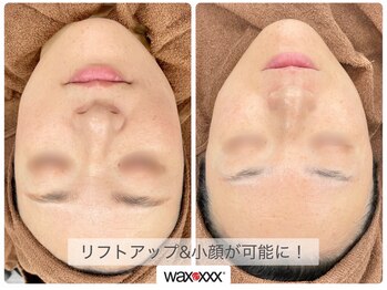 ビュー(Beau)/スキンケアWAX脱毛