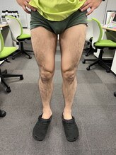 フレッシュ脱毛ドットコム(Flesh脱毛.com)/脚まるごと脱毛 施術前