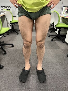 フレッシュ脱毛ドットコム(Flesh脱毛.com)/脚まるごと脱毛 施術前